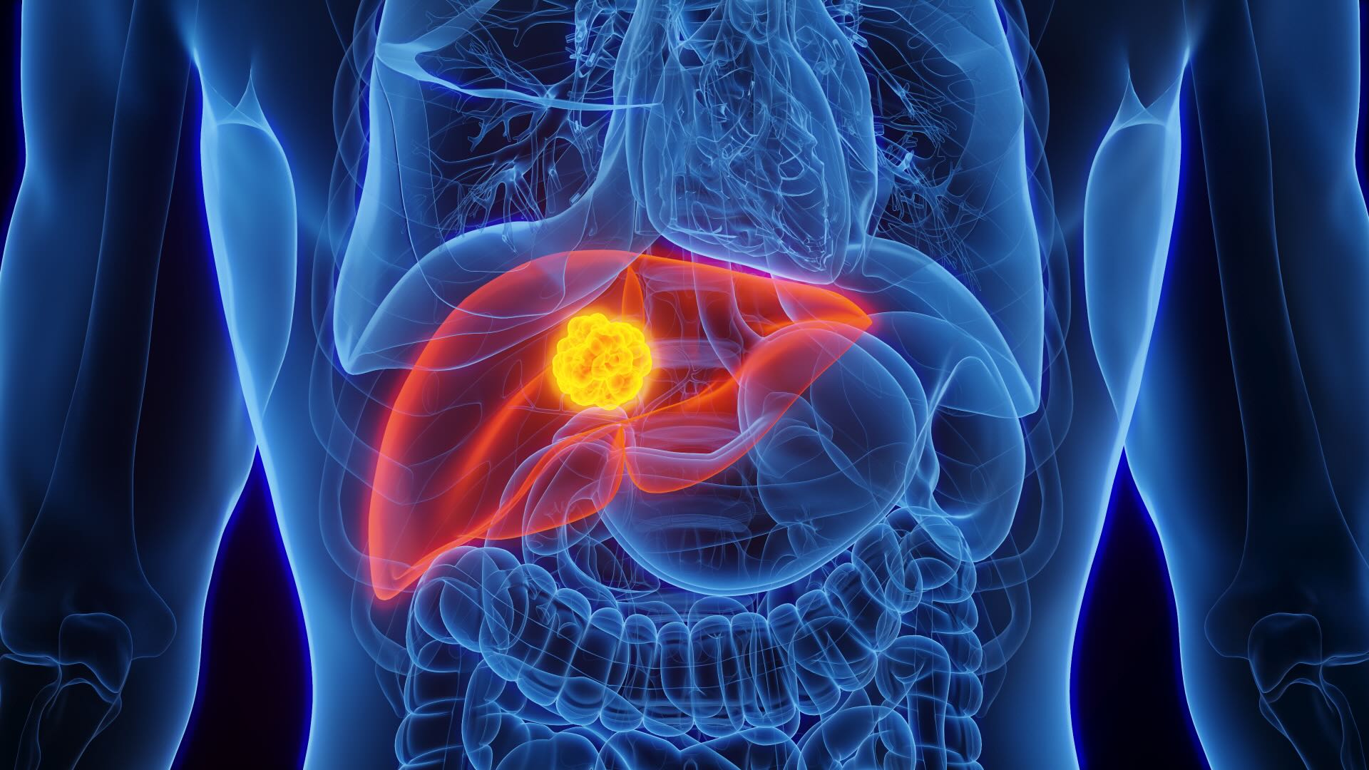 3D Rendered Medical Illustration of Male Anatomy - Liver Cancer. Plain Black Background. Close up. Anterior View