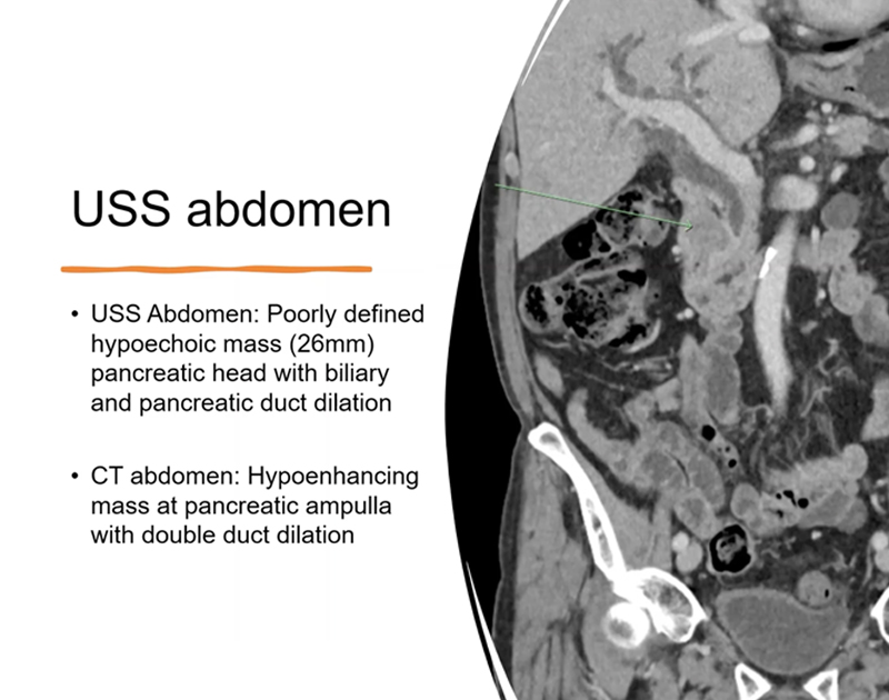 USS abdomen:Poorly defined hypoechoic mass pancreatic head with biliary and pancreatic duct dilation