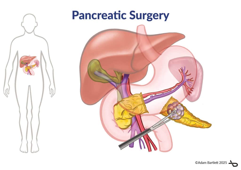 Pancreatic Surgery