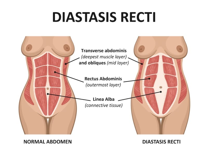 Diastasis recti. Abdominal muscle diastasis after pregnancy pregnancy and childbirth.