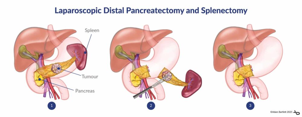 Pancreatic Surgery: Laparoscopic Distal Pancreatectomy and Splenectomy