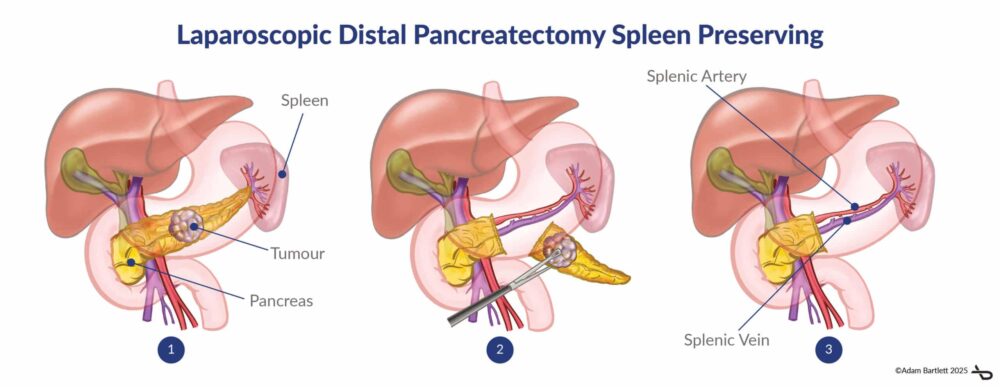 Pancreatic Surgery: Laparoscopic Distal Pancreatectomy Spleen Preserving