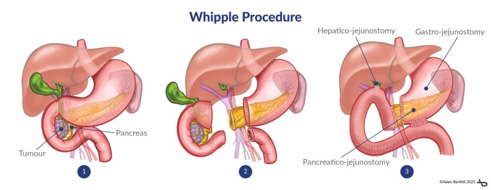 Pancreatic Surgery: Whipple Procedure