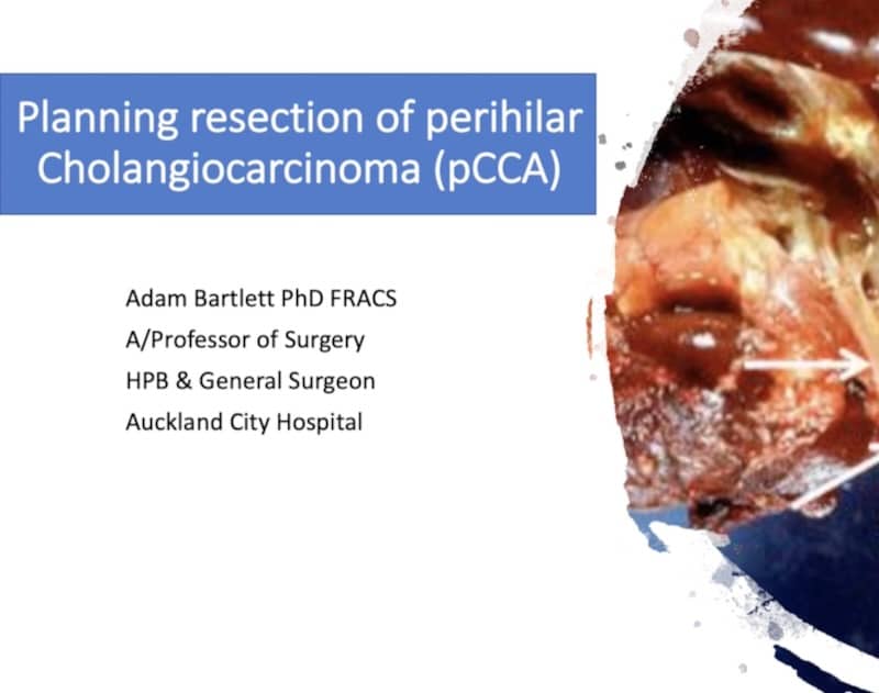 Hilar cholangiocarcinoma pCCA